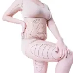 Comment perdre du poids grâce à la liposuccion VASER ?