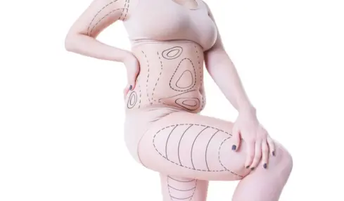 Comment perdre du poids grâce à la liposuccion VASER ?